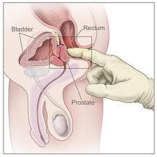 prostat adenomu hipertansiyon)